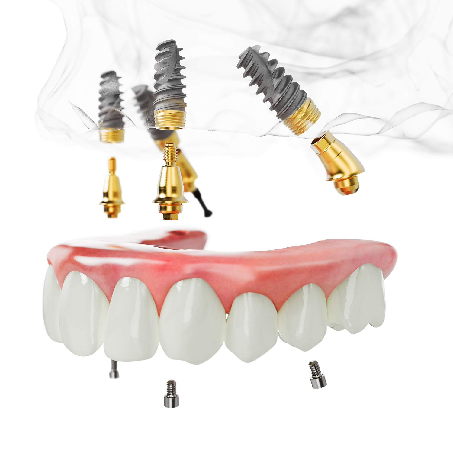 All-on-4 Essen – Feste Zähne an einem Tag