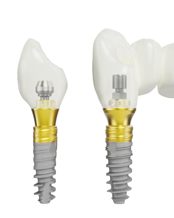 Einzelzahnimplantat 5 Jahre Garantie